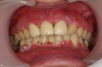 Nekrotiserande ulcer&ouml;s gingivit